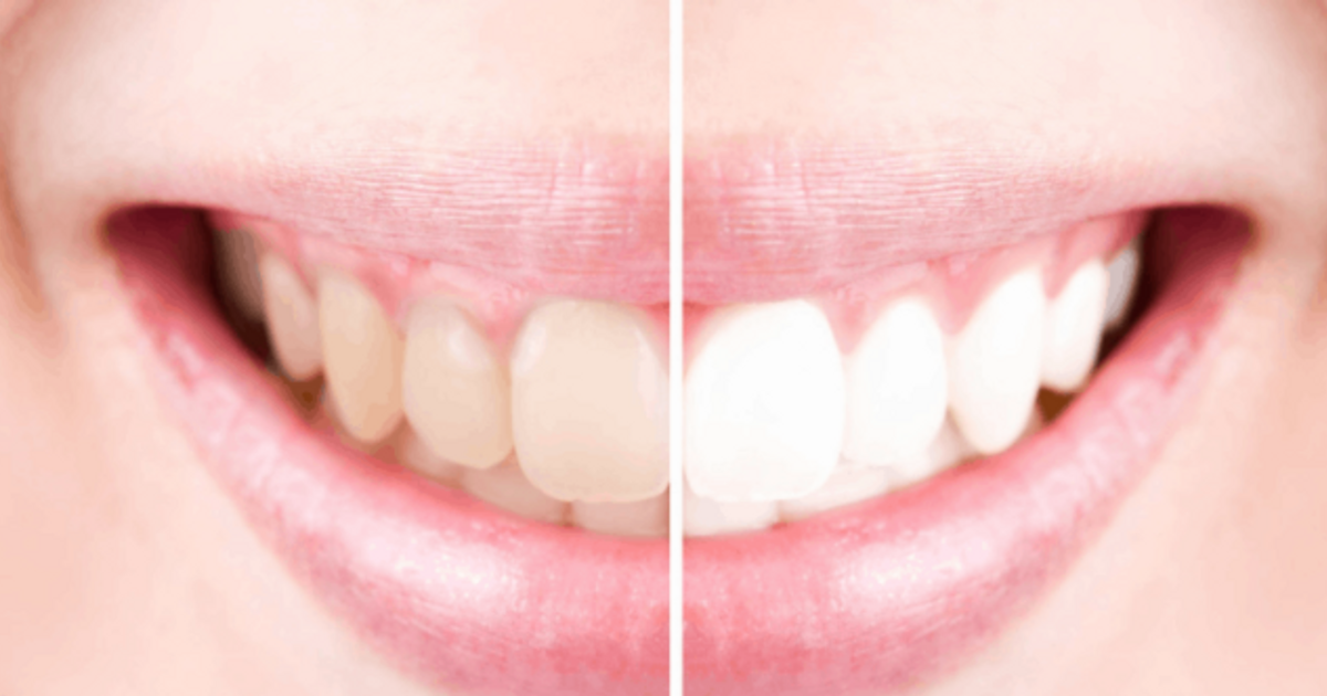 Зуб после душа. Зубы с пигментацией после отбеливания. Что нельзя после отбеливания зубов пиктограммы.